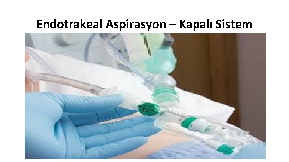 Endotrakeal Aspirasyon – Kapalı Sistem 