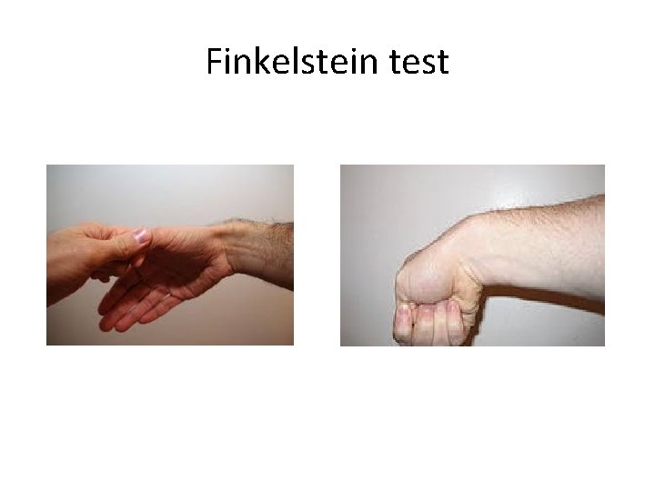 Finkelstein test 