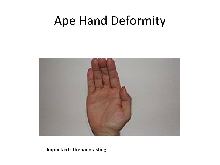 Ape Hand Deformity Important: Thenar wasting 