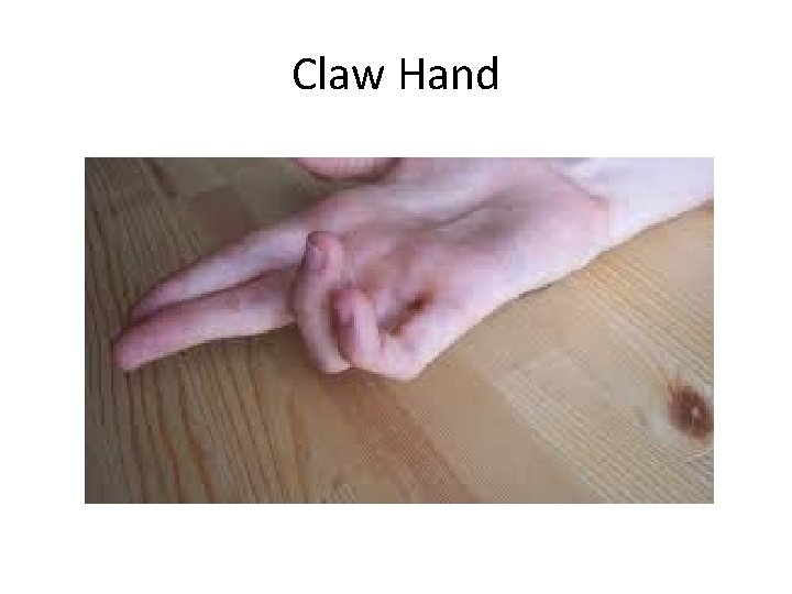 Claw Hand 