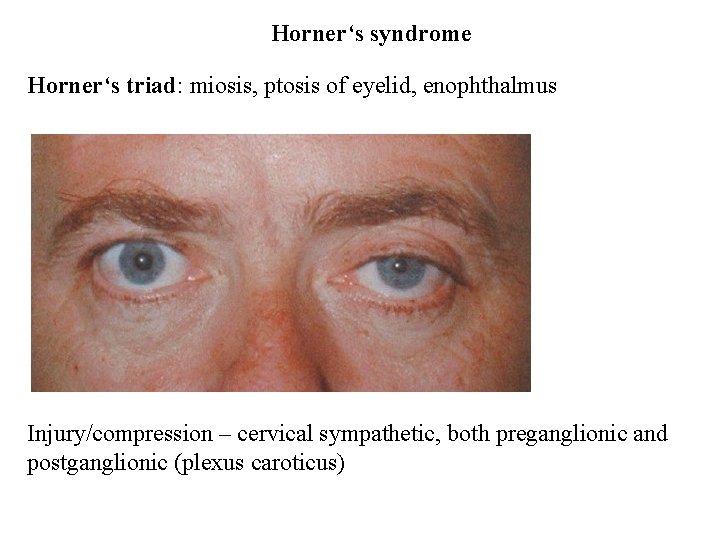 Horner‘s syndrome Horner‘s triad: miosis, ptosis of eyelid, enophthalmus Injury/compression – cervical sympathetic, both