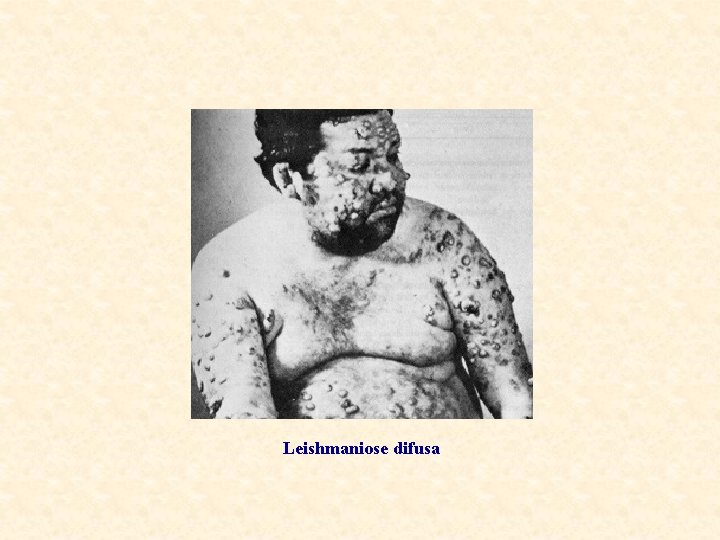 Leishmaniose difusa 