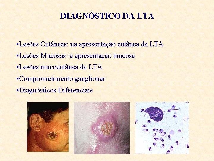 DIAGNÓSTICO DA LTA • Lesões Cutâneas: na apresentação cutânea da LTA • Lesões Mucosas: