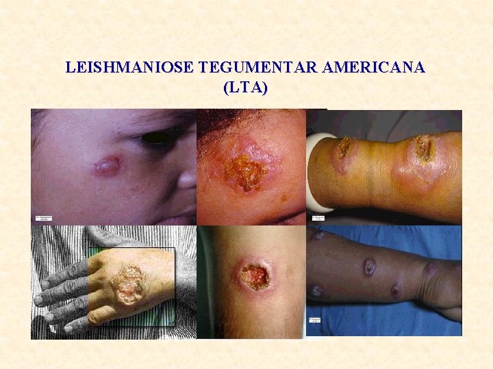 LEISHMANIOSE TEGUMENTAR AMERICANA (LTA) 