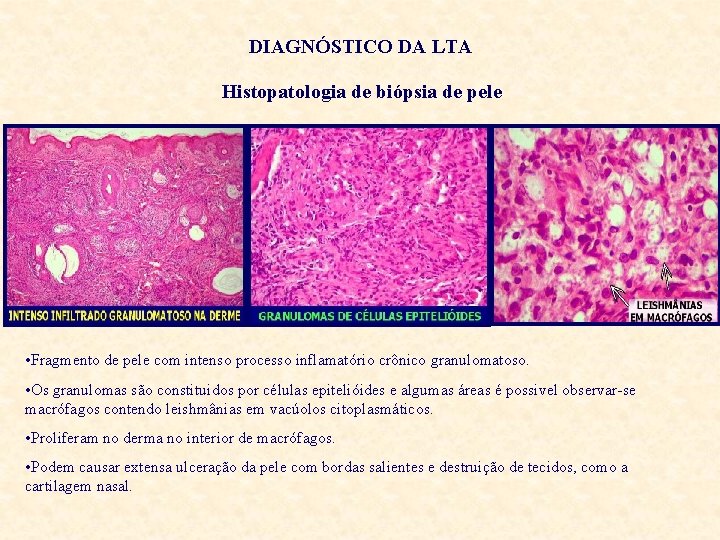 DIAGNÓSTICO DA LTA Histopatologia de biópsia de pele • Fragmento de pele com intenso