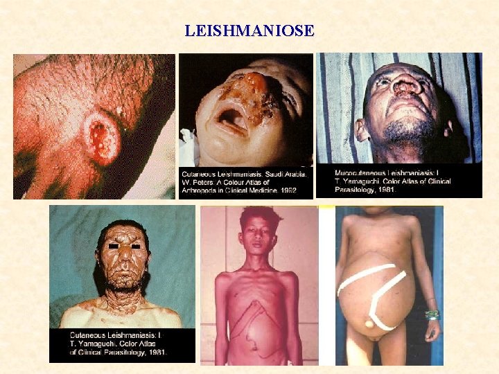 LEISHMANIOSE 