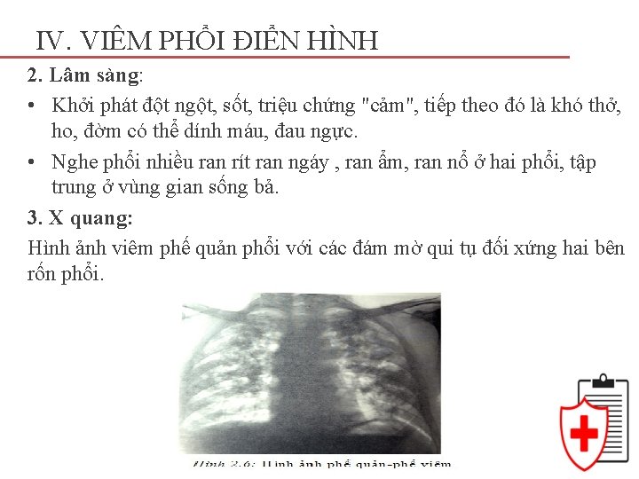 IV. VIÊM PHỔI ĐIỂN HÌNH 2. Lâm sàng: • Khởi phát đột ngột, sốt,