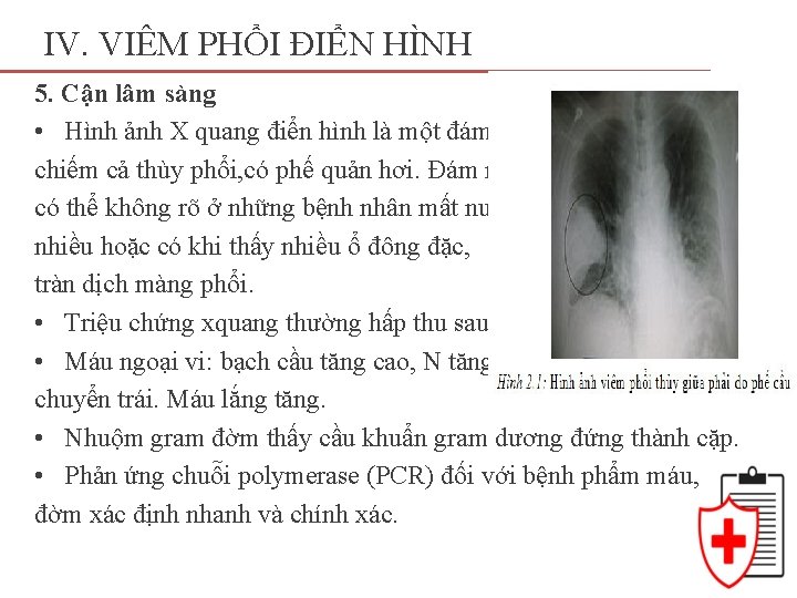 IV. VIÊM PHỔI ĐIỂN HÌNH 5. Cận lâm sàng • Hình ảnh X quang