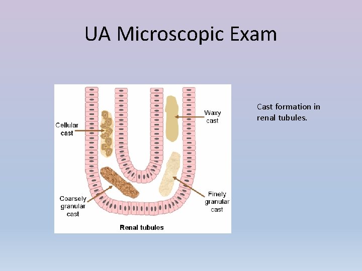 UA Microscopic Exam Cast formation in renal tubules. 