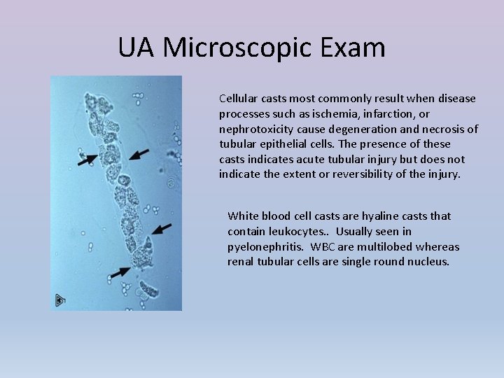 UA Microscopic Exam Cellular casts most commonly result when disease processes such as ischemia,
