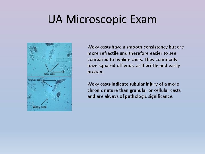 UA Microscopic Exam Waxy casts have a smooth consistency but are more refractile and