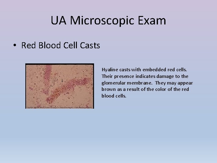 UA Microscopic Exam • Red Blood Cell Casts Hyaline casts with embedded red cells.