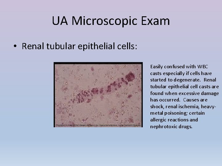 UA Microscopic Exam • Renal tubular epithelial cells: Easily confused with WBC casts especially