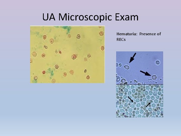 UA Microscopic Exam Hematuria: Presence of RBCs 