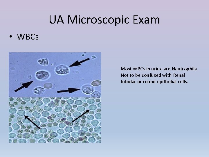 UA Microscopic Exam • WBCs Most WBCs in urine are Neutrophils. Not to be