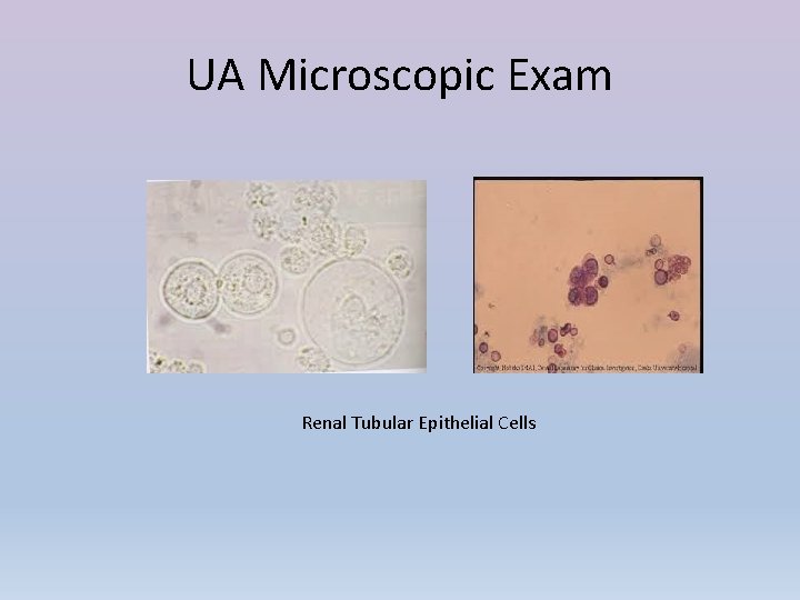 UA Microscopic Exam Renal Tubular Epithelial Cells 