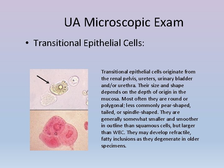 UA Microscopic Exam • Transitional Epithelial Cells: Transitional epithelial cells originate from the renal