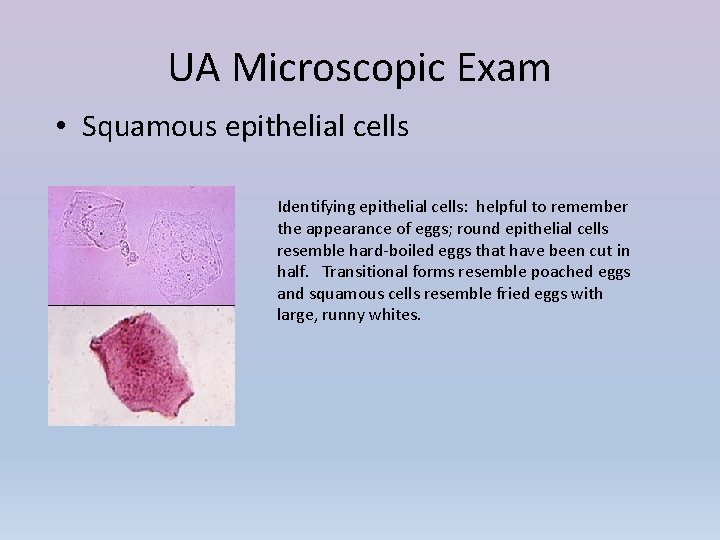 UA Microscopic Exam • Squamous epithelial cells Identifying epithelial cells: helpful to remember the