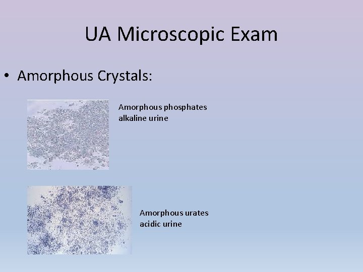 UA Microscopic Exam • Amorphous Crystals: Amorphous phosphates alkaline urine Amorphous urates acidic urine