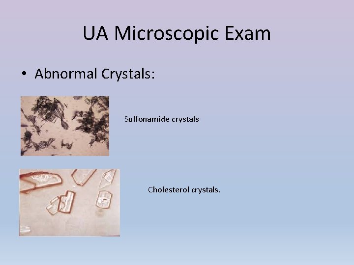 UA Microscopic Exam • Abnormal Crystals: Sulfonamide crystals Cholesterol crystals. 