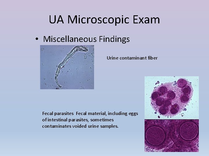 UA Microscopic Exam • Miscellaneous Findings Urine contaminant fiber Fecal parasites Fecal material, including
