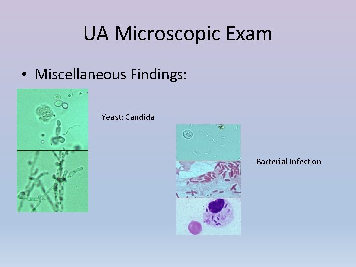 UA Microscopic Exam • Miscellaneous Findings: Yeast; Candida Bacterial Infection 