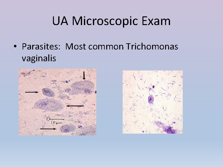 UA Microscopic Exam • Parasites: Most common Trichomonas vaginalis 