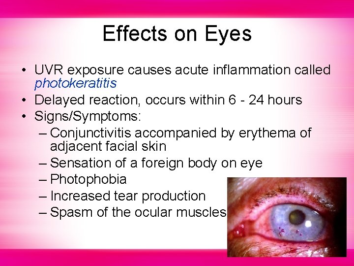 Effects on Eyes • UVR exposure causes acute inflammation called photokeratitis • Delayed reaction,