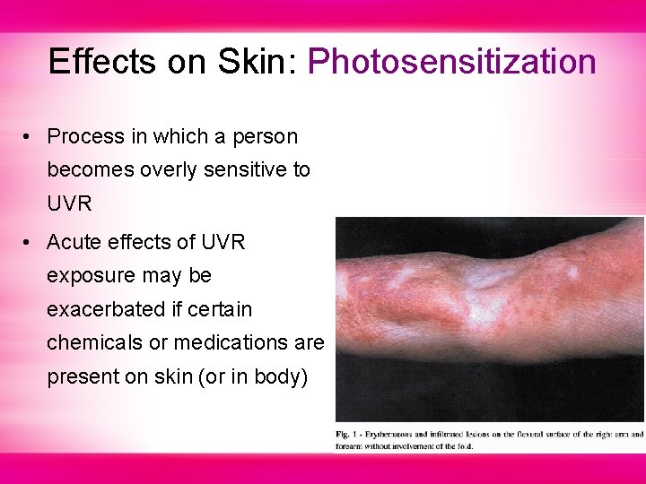Effects on Skin: Photosensitization • Process in which a person becomes overly sensitive to