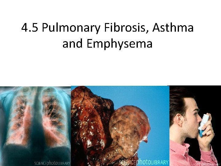4. 5 Pulmonary Fibrosis, Asthma and Emphysema 