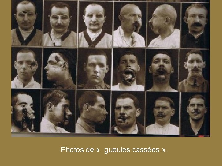 Photos de « gueules cassées » . 