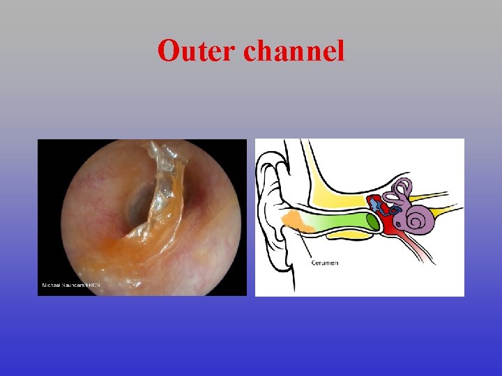 Outer channel 