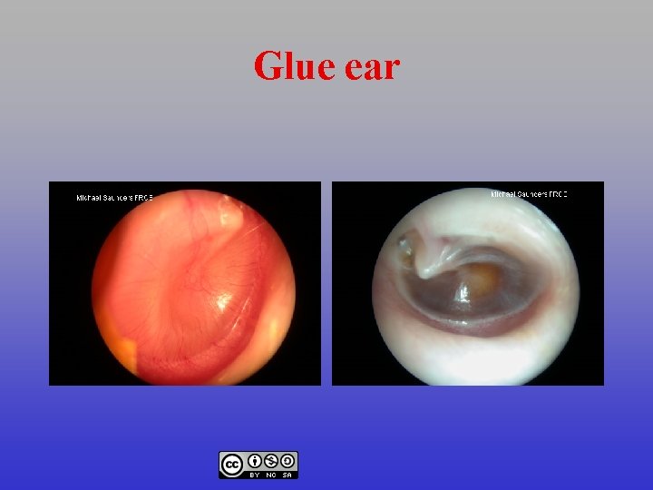 Glue ear 