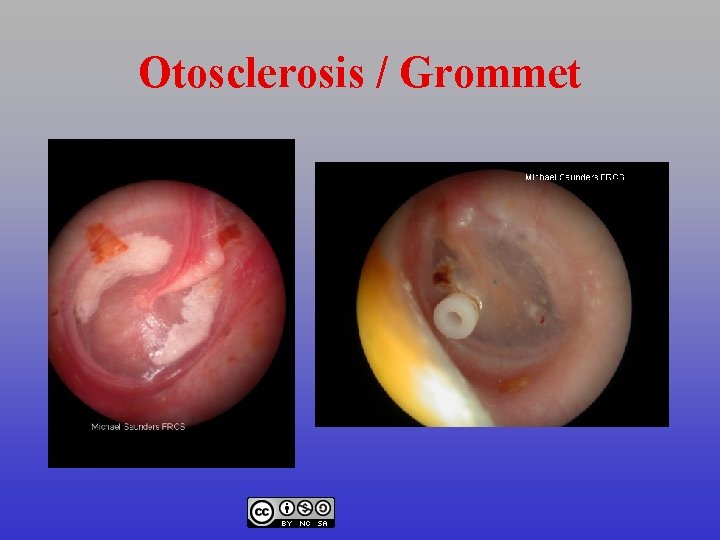 Otosclerosis / Grommet 