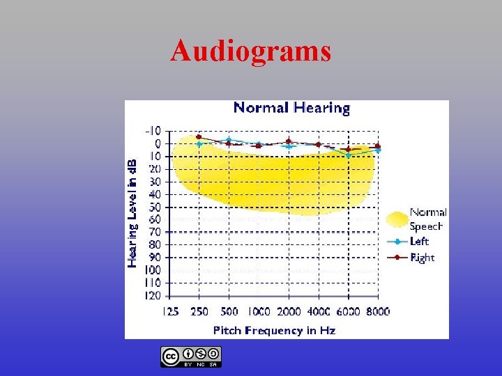 Audiograms 