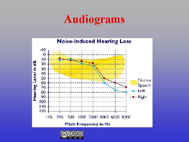 Audiograms 