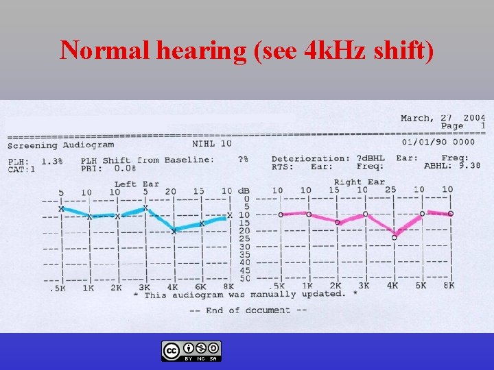 Normal hearing (see 4 k. Hz shift) 