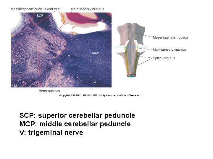 SCP: superior cerebellar peduncle MCP: middle cerebellar peduncle V: trigeminal nerve 