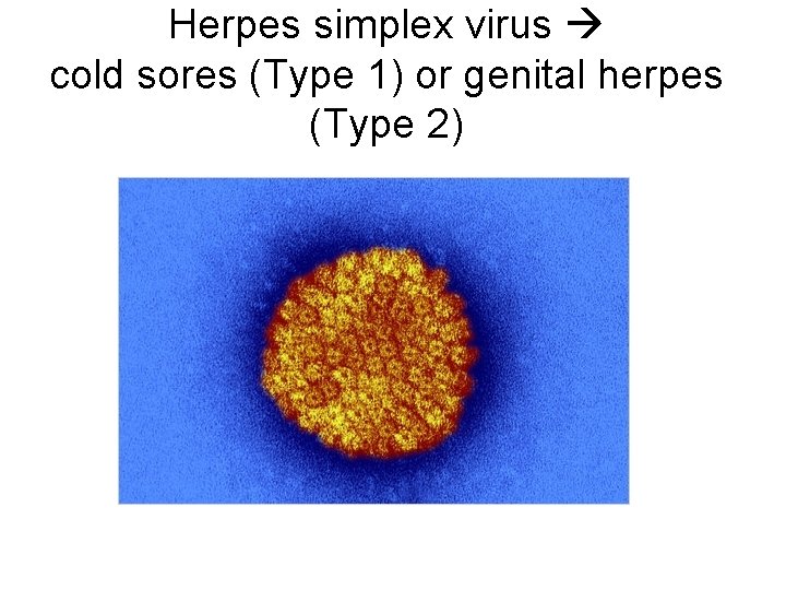 Herpes simplex virus cold sores (Type 1) or genital herpes (Type 2) 