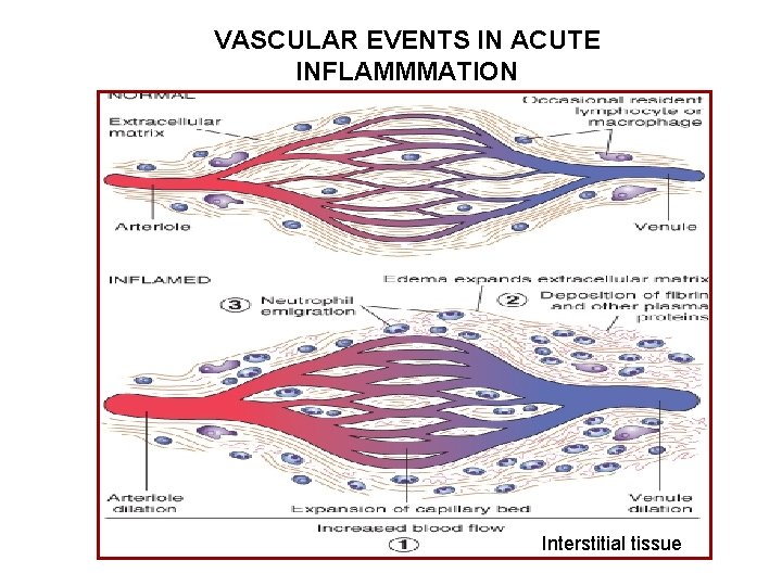 VASCULAR EVENTS IN ACUTE INFLAMMMATION Interstitial tissue 