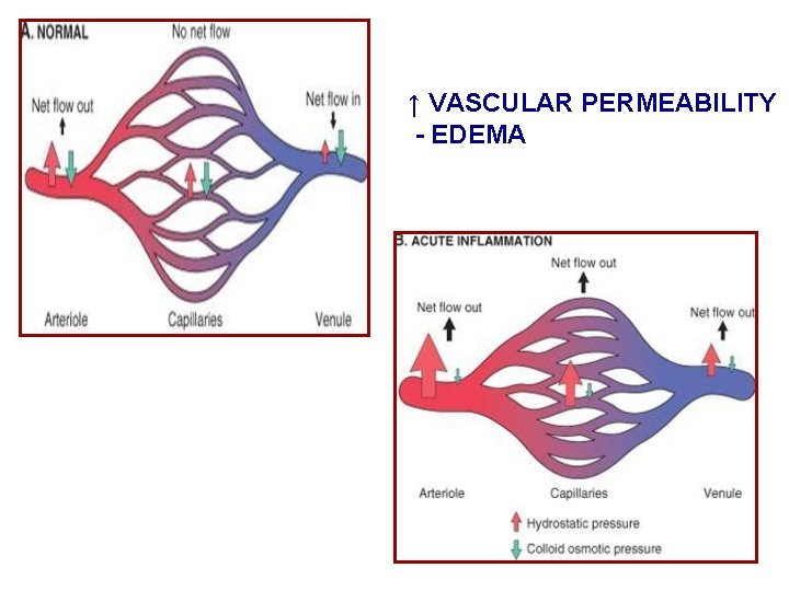 ↑ VASCULAR PERMEABILITY - EDEMA 