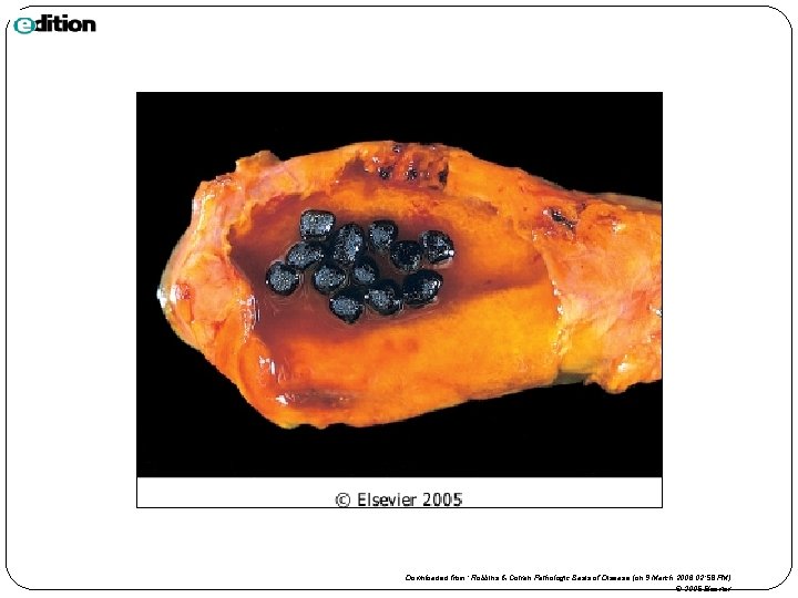 Downloaded from: Robbins & Cotran Pathologic Basis of Disease (on 9 March 2006 02: