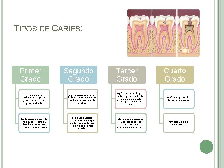 TIPOS DE CARIES: Primer Grado Segundo Grado Tercer Grado Cuarto Grado Esta caries es