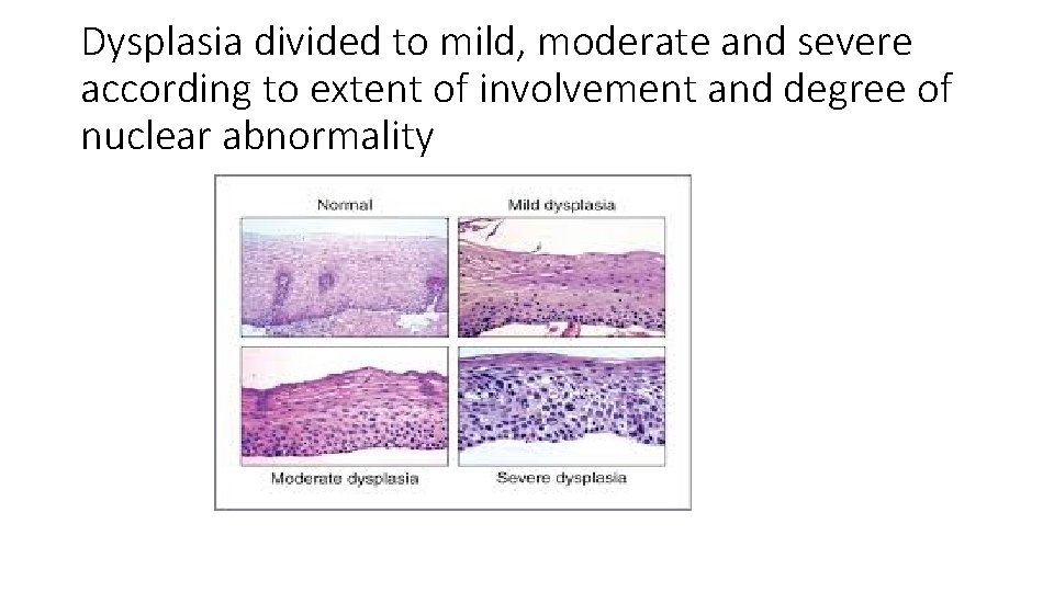 Dysplasia divided to mild, moderate and severe according to extent of involvement and degree