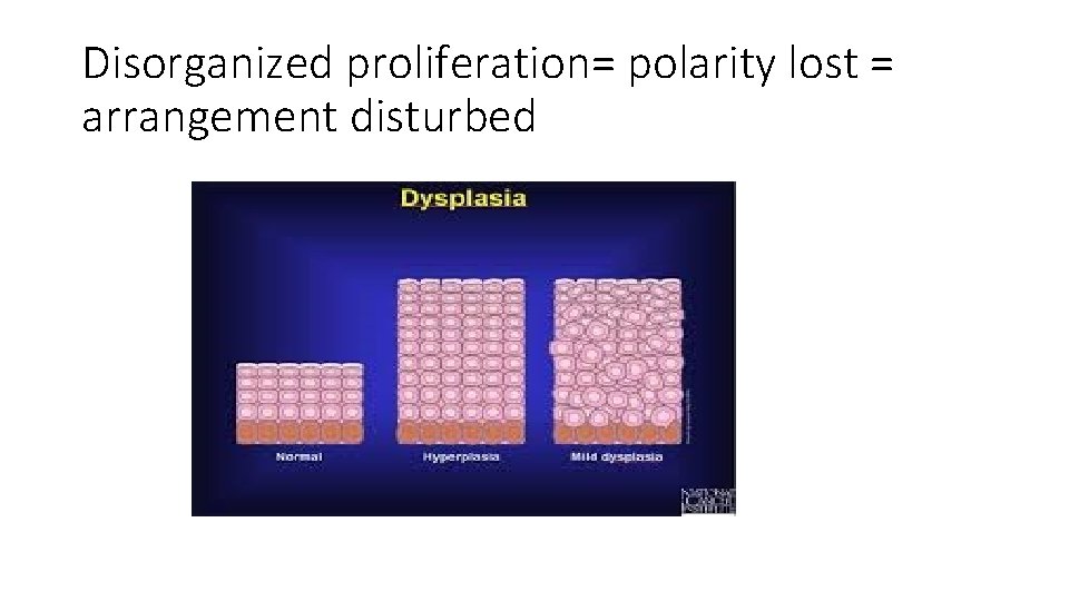 Disorganized proliferation= polarity lost = arrangement disturbed 