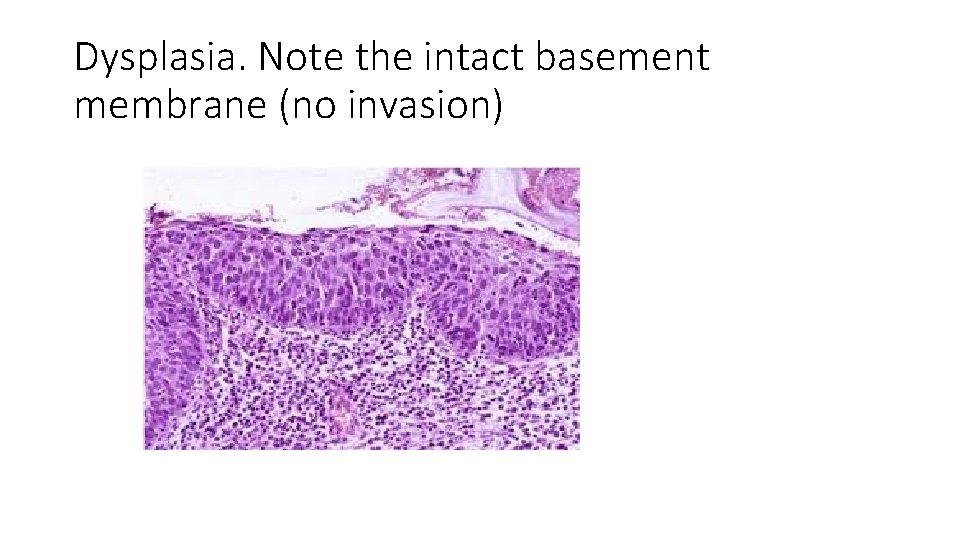 Dysplasia. Note the intact basement membrane (no invasion) 