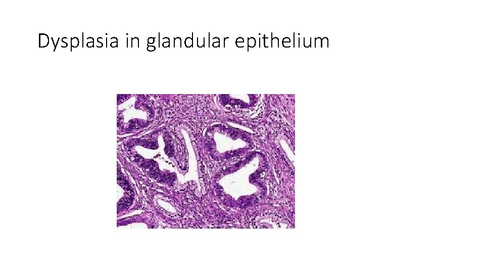 Dysplasia in glandular epithelium 