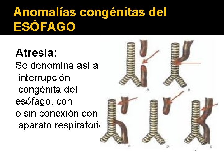 Anomalías congénitas del ESÓFAGO Atresia: Se denomina así a la interrupción congénita del esófago,