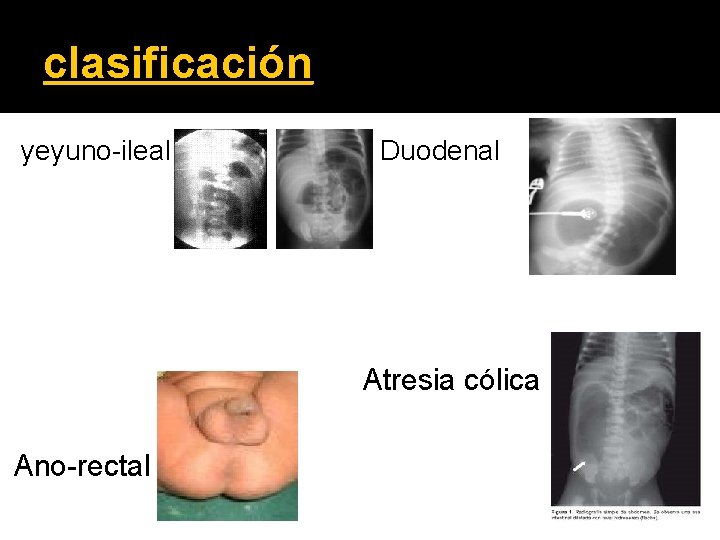 clasificación Atresia duodenal. yeyuno-ileal Duodenal Atresia cólica Ano-rectal 