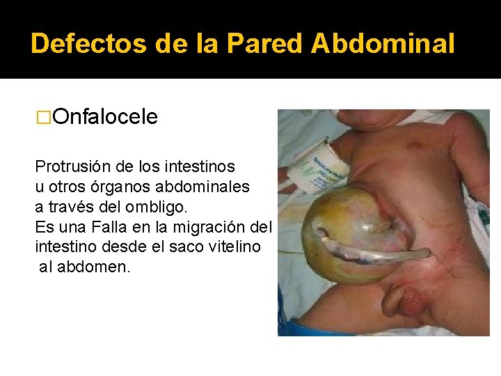 Defectos de la Pared Abdominal �Onfalocele Protrusión de los intestinos u otros órganos abdominales